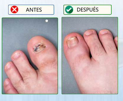 Parches ANTI-HONGO para uñas - ¡SUPER OFERTA 2x1!