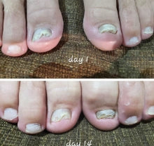 Parches ANTI-HONGO para uñas - ¡SUPER OFERTA 2x1!